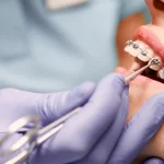 especializações em odontologia: mão de um dentista com luva azul mexendo no sorriso do paciente que utiliza aparelho ortodontico
